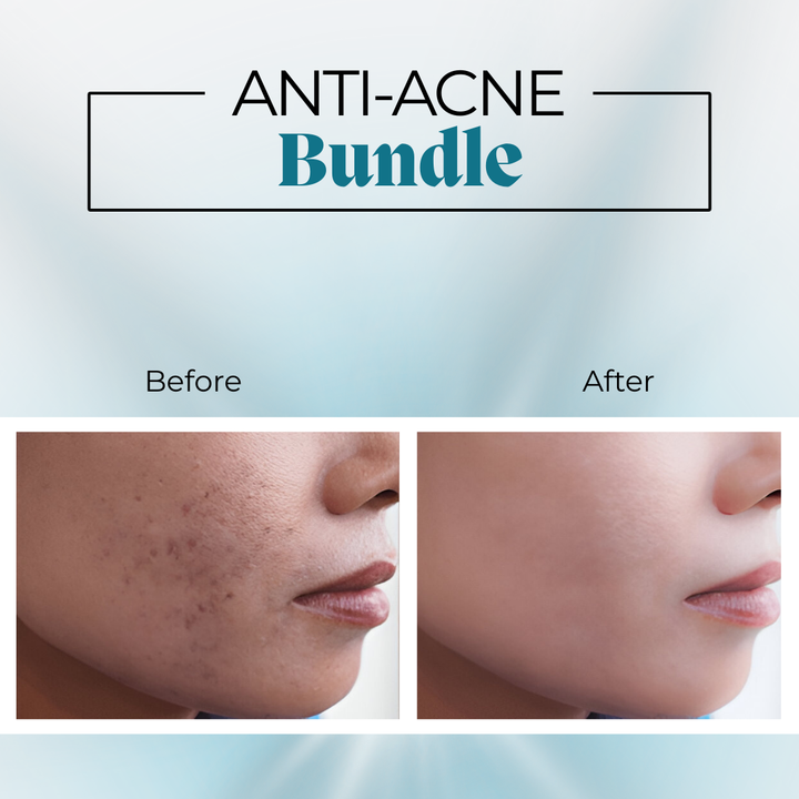 Best anti acne bundle for skin
